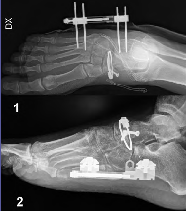 Acute Navicular Fractures Report Of Two Cases And Review Of The 